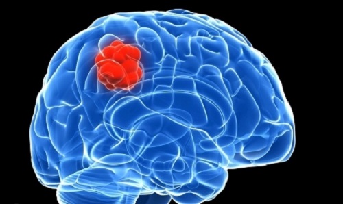 ما علاقة الشاي بسرطان الدمّاغ؟