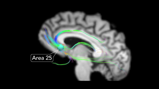 "بطارية الدماغ" أمل الأطباء