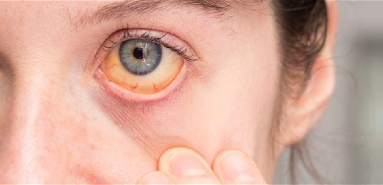 "اليرقان" مش لعبة.. وتحذير من الأسوأ