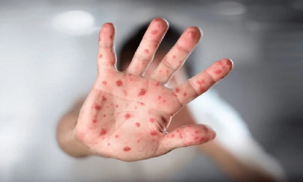 الصحة العالمية: أوروبا تتجه لاحتواء جدري القردة