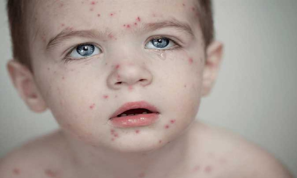 &ldquo;الحصبة تنتشر&rdquo;.. والابيض يدق ناقوس الخطر