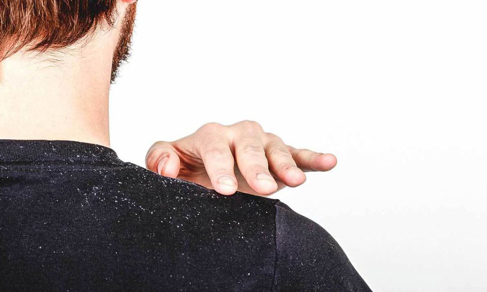 ما أسباب ظهور قشرة الرأس؟