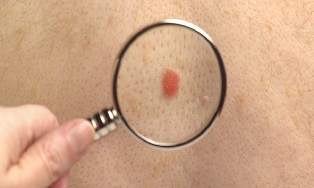 علامات تشير إلى سرطان الجلد